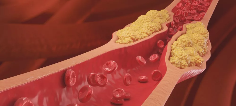 High Cholesterol and Vascular Stiffness